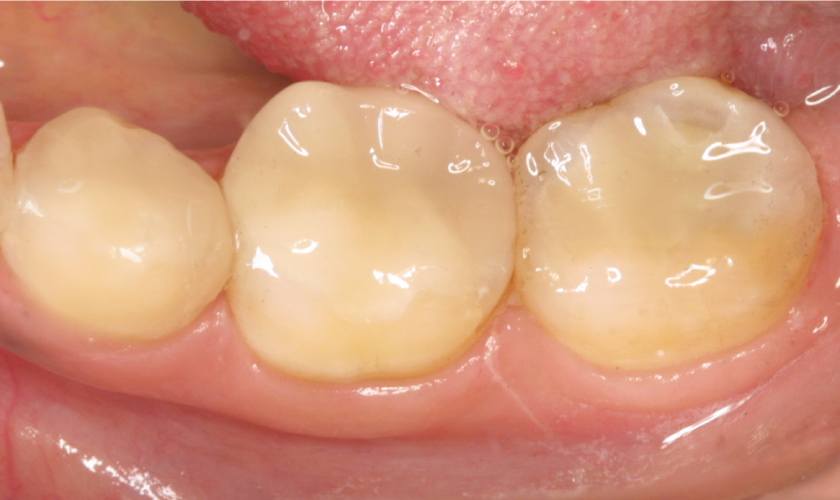 Trám răng loại nào tốt nhất?